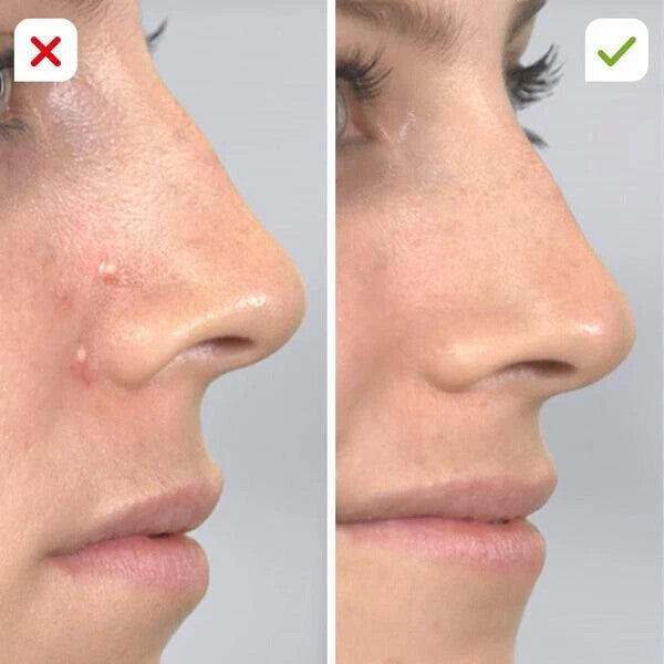 DermaSuction-Vakuum-Hautreiniger Mitesser Entferner Porenreiniger Reine Haut