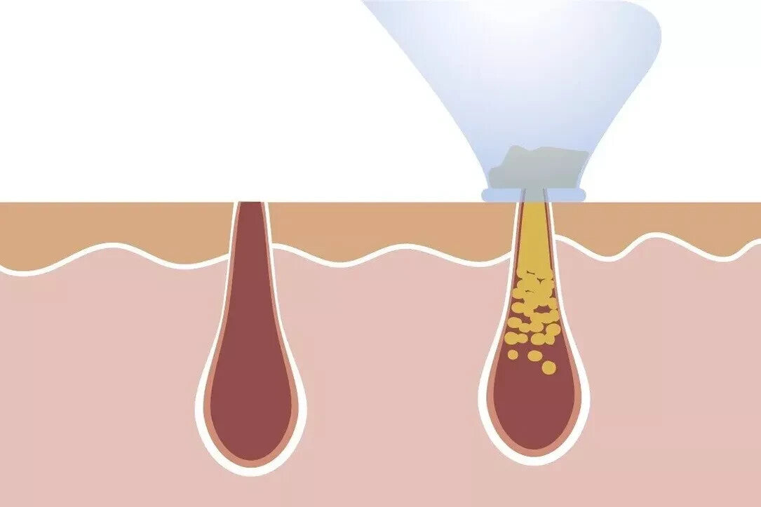 DermaSuction-Vakuum-Hautreiniger Mitesser Entferner Porenreiniger Reine Haut
