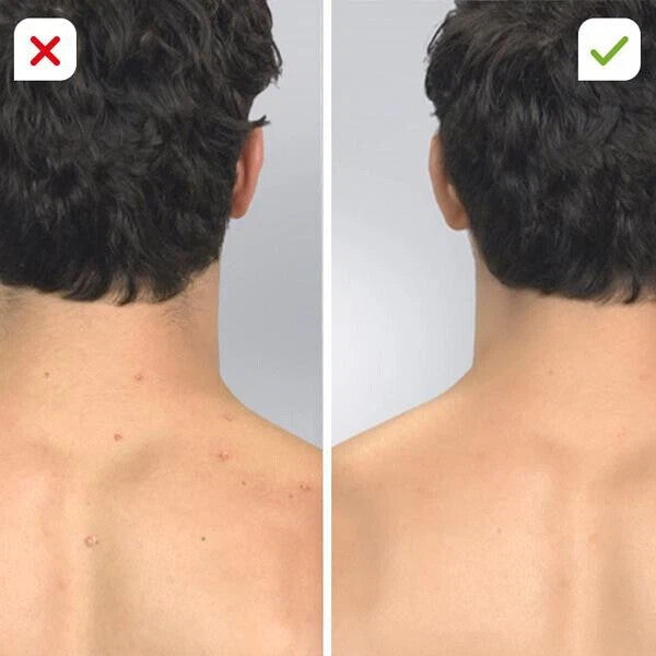 DermaSuction-Vakuum-Hautreiniger Mitesser Entferner Porenreiniger Reine Haut
